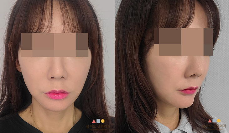 수술 후