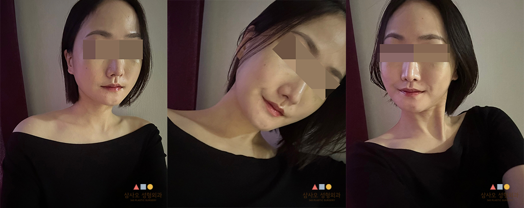 수술 후