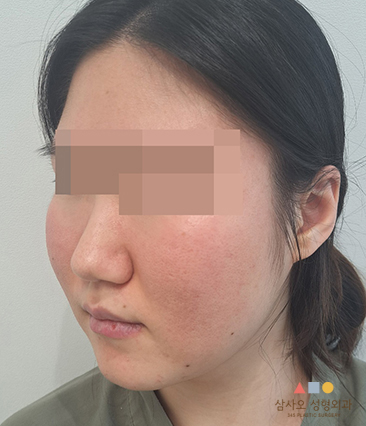 수술 전