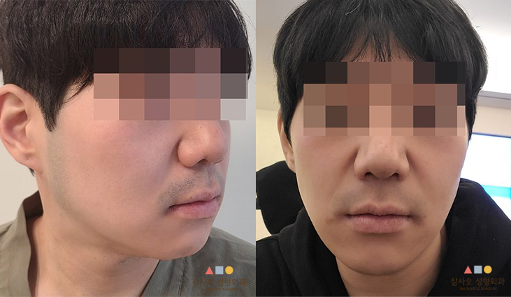 수술 전