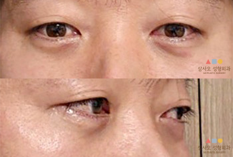 수술 후