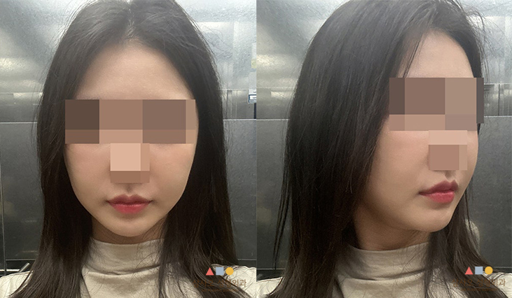 수술 후