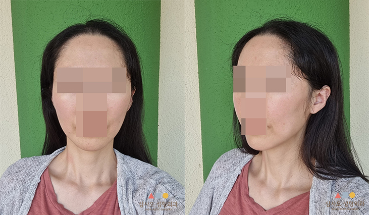 수술 후