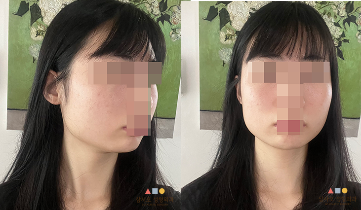 수술 전