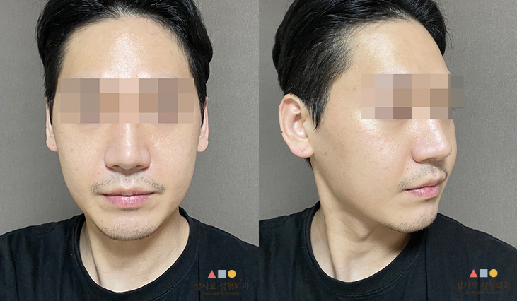 수술 후