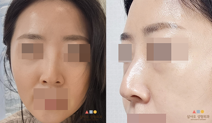수술 전