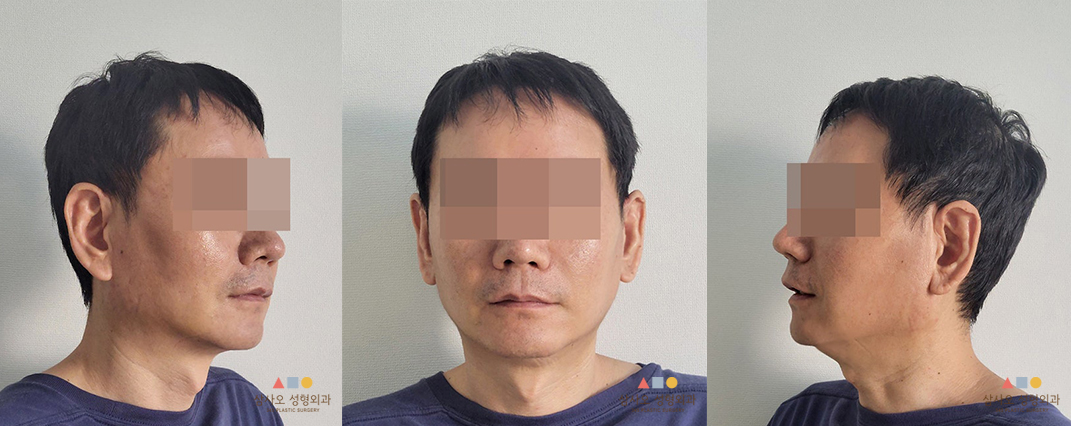 수술 후