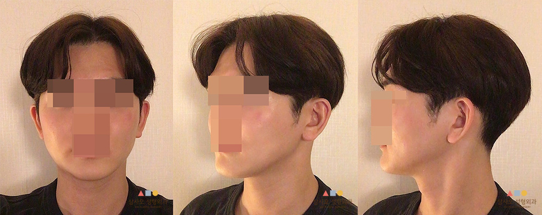 수술 전