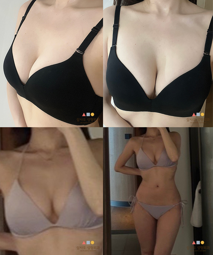 수술 후