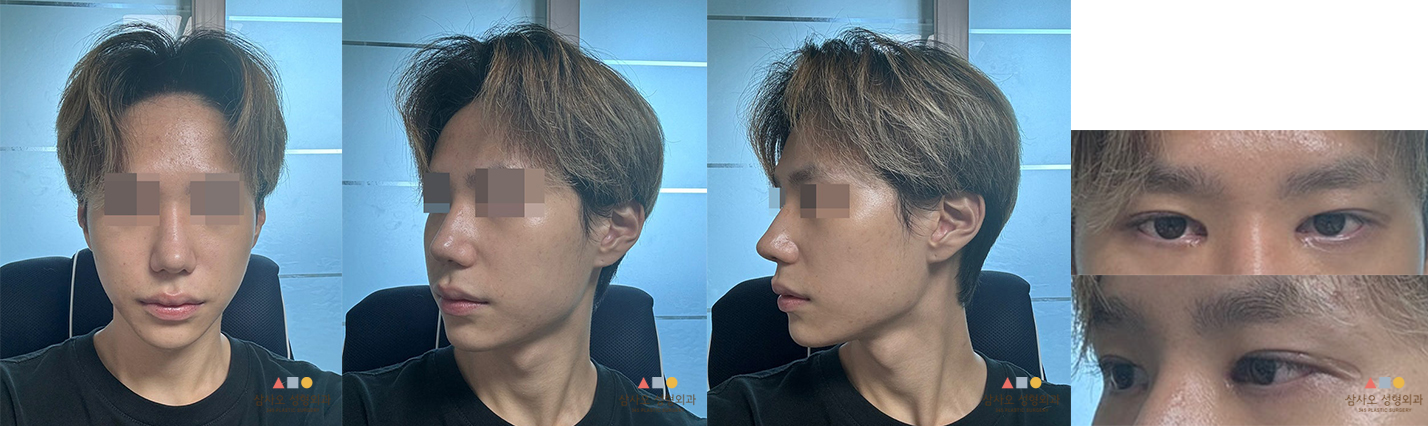 수술 후