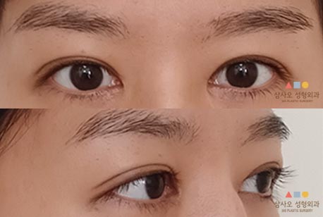 수술 후