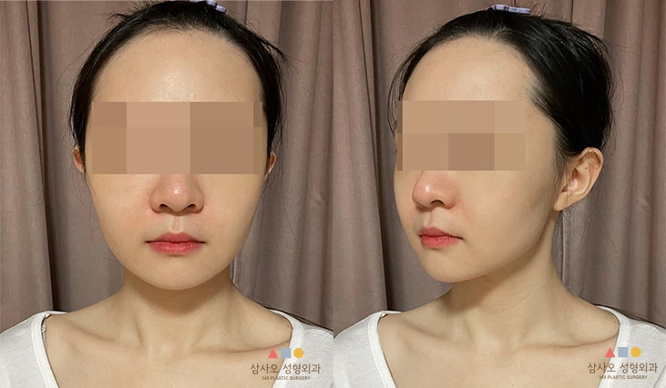 수술 후