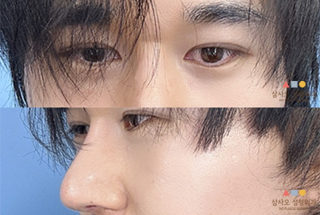 수술 후