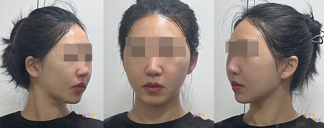 수술 후
