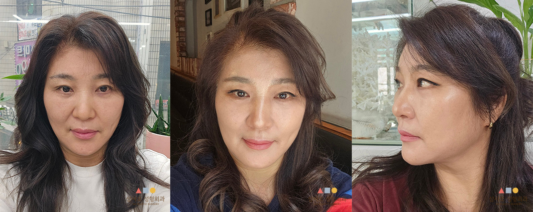 수술 후