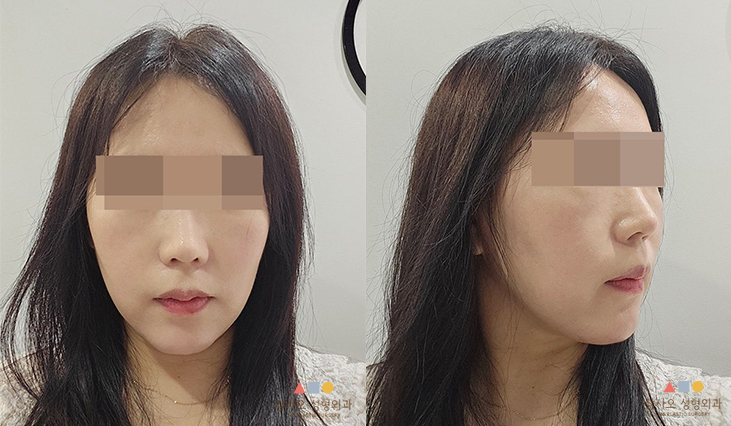 수술 후