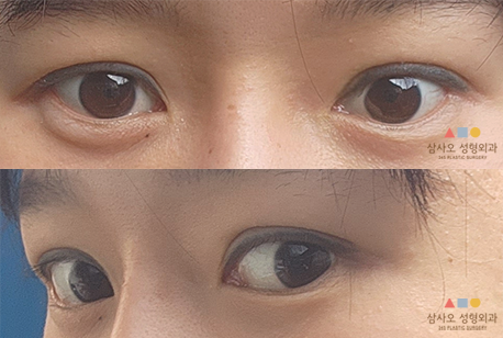 수술 후
