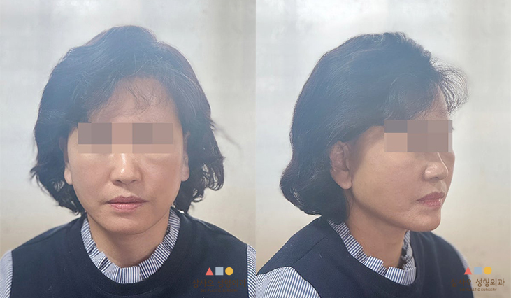 수술 후