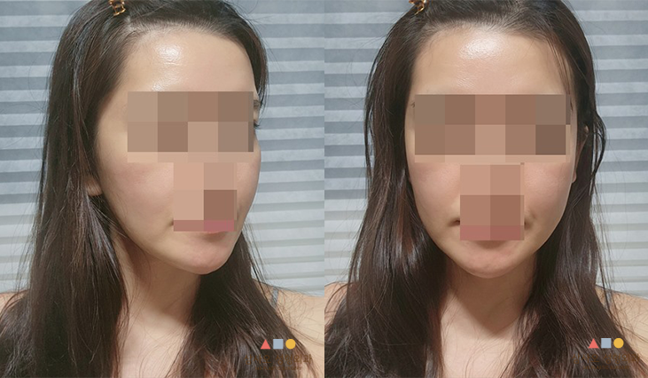 수술 후
