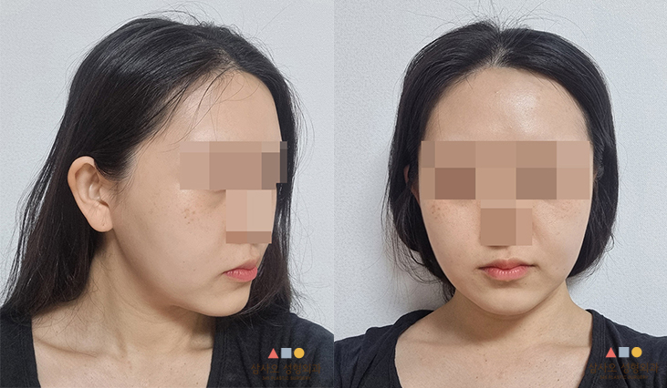 수술 후