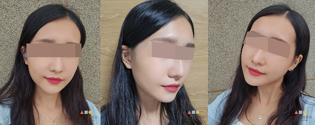 수술 후