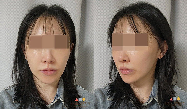 수술 후