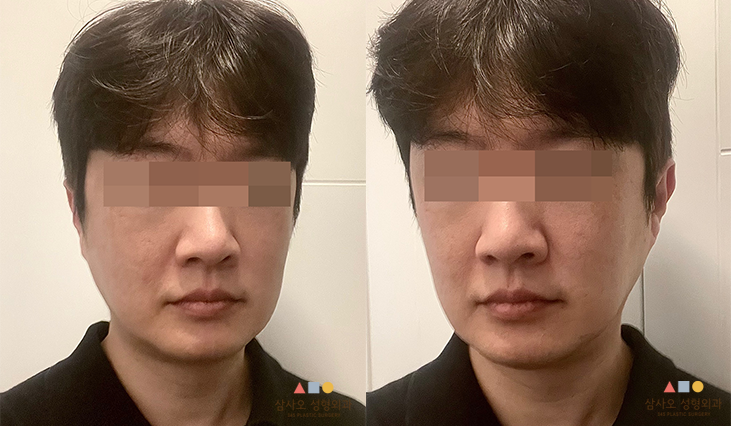 수술 전