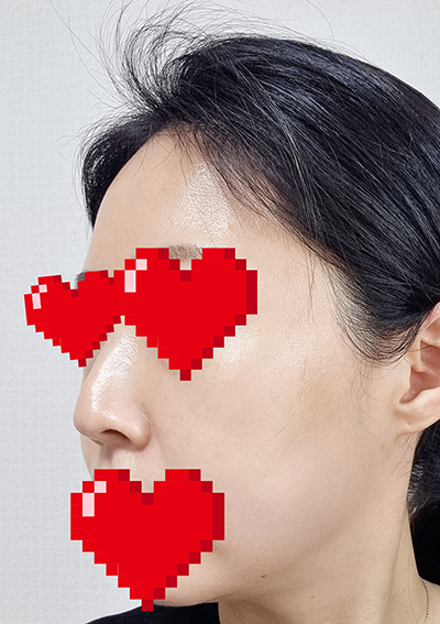 수술 전
