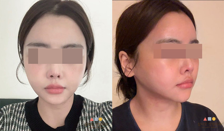 수술 후