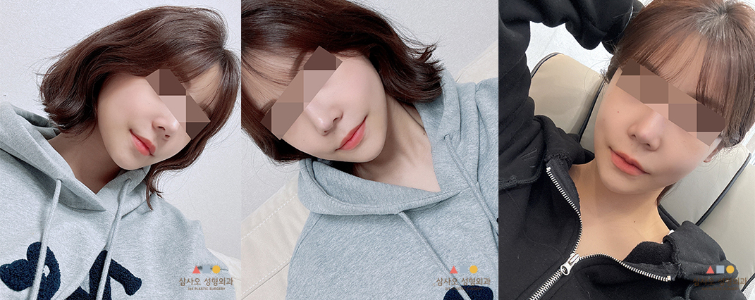 수술 후