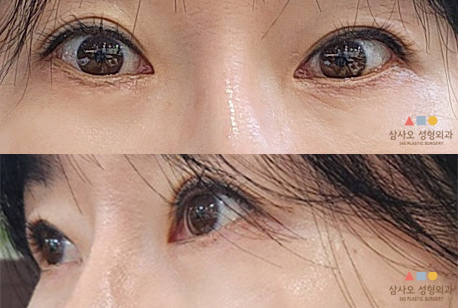 수술 후
