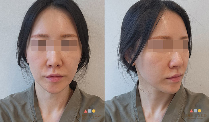 수술 전