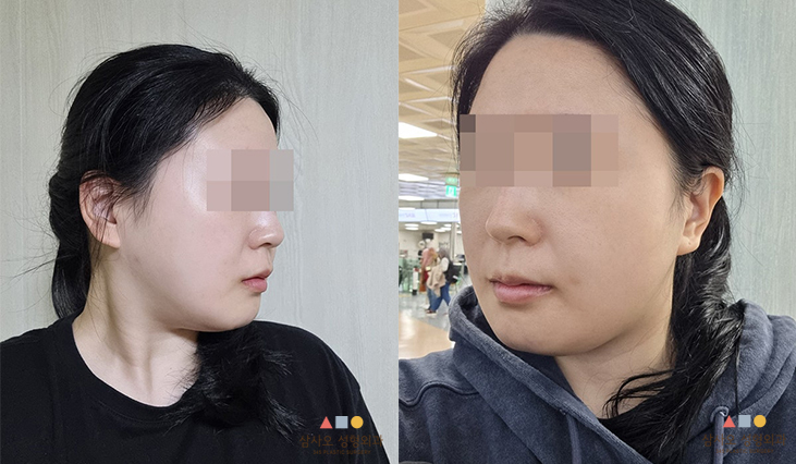 수술 후