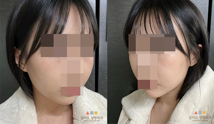 수술 후