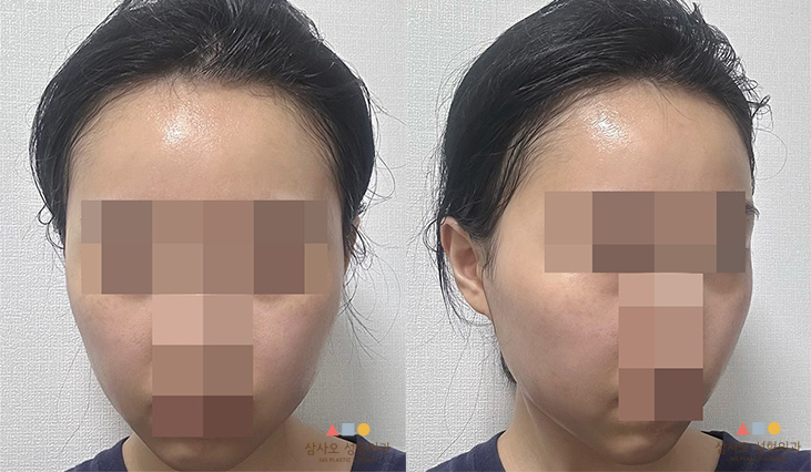 수술 후