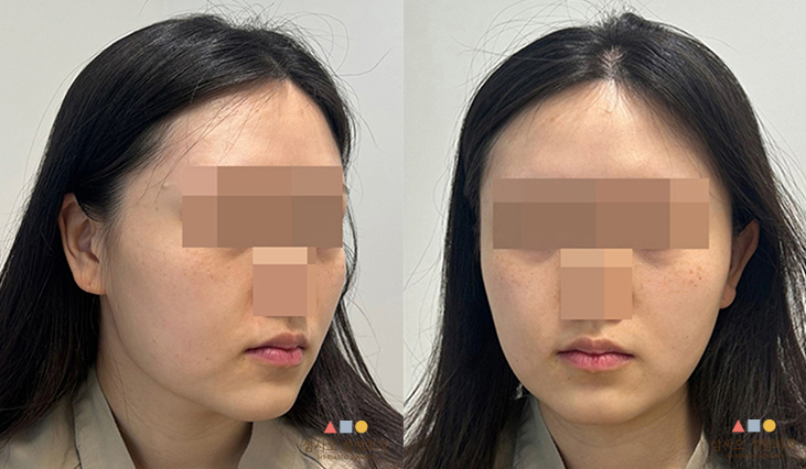 수술 전