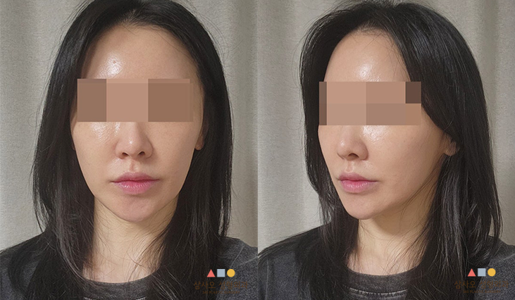 수술 후