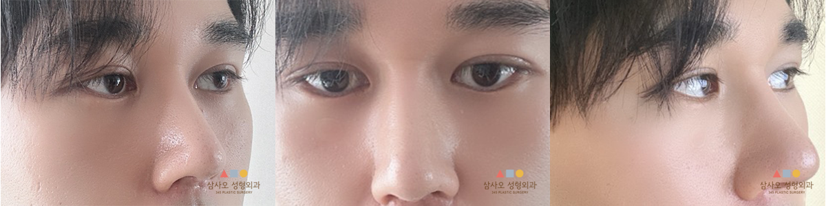 수술 후