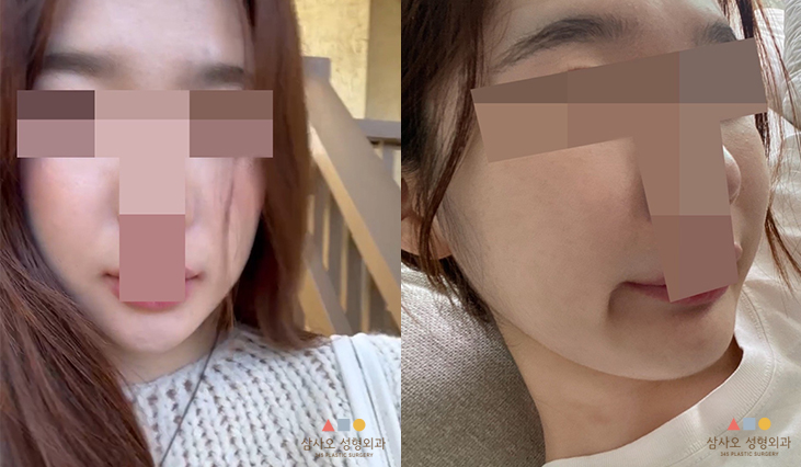 수술 후