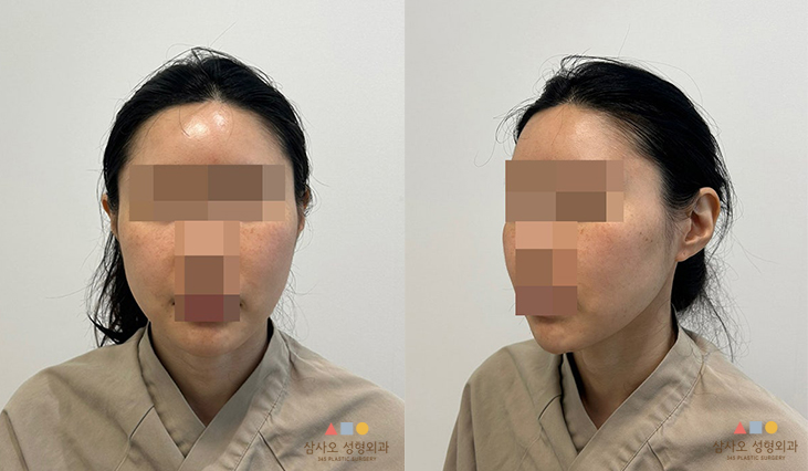 수술 전