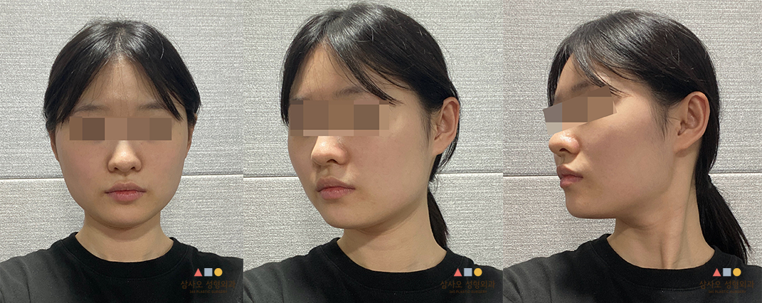 수술 전