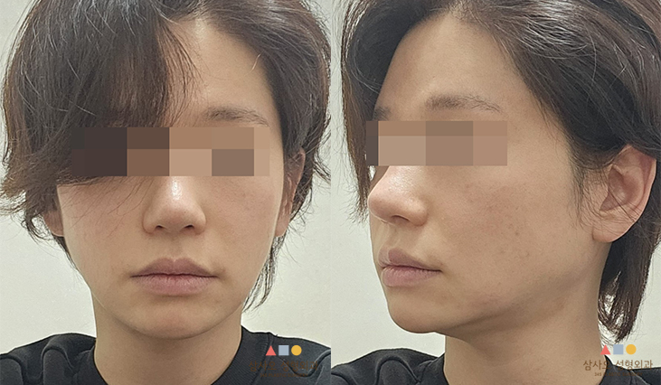 수술 전