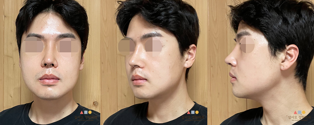 수술 후