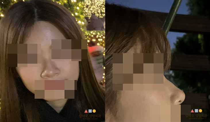 수술 전