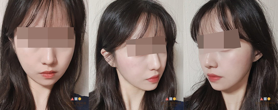 수술 후