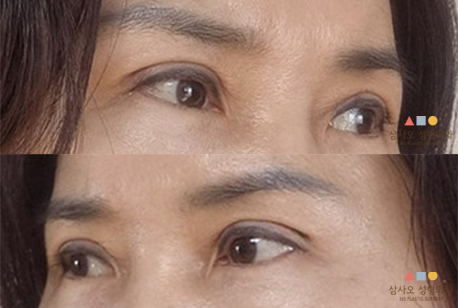 수술 후