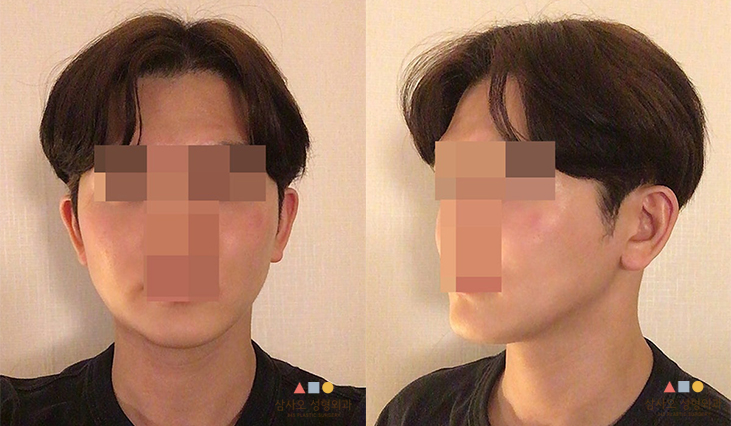 수술 전