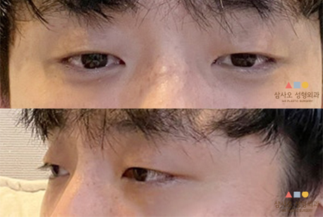 수술 후