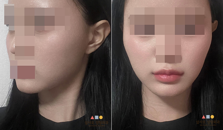 수술 전