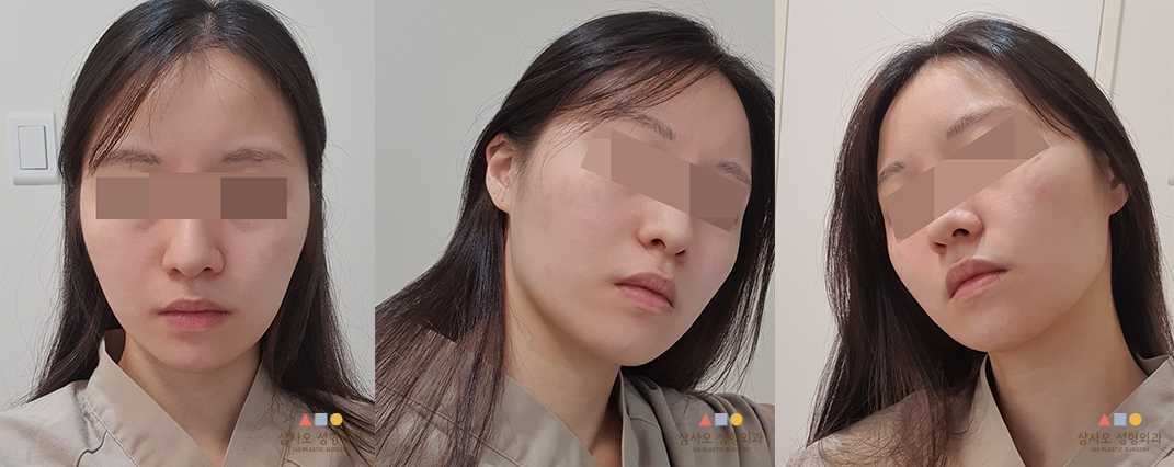 수술 전